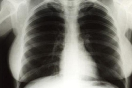 Рентгеновские снимки Мэрилин Монро продали за 45 тыс. долларов