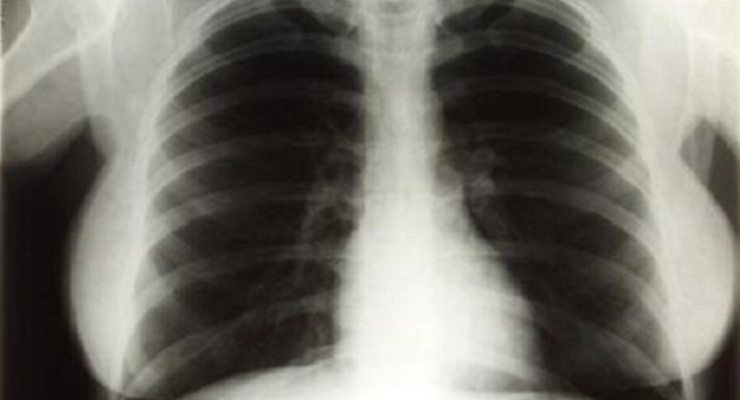 Рентгеновские снимки Мэрилин Монро продали за 45 тыс. долларов