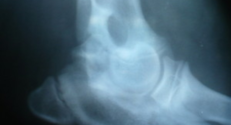 Из-за травмированных киевлян возбуждено уже 7 уголовных дел