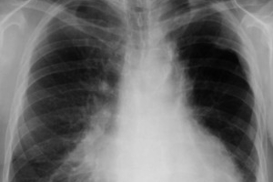 Первая смерть от пневмонии зафиксирована в Херсонской области
