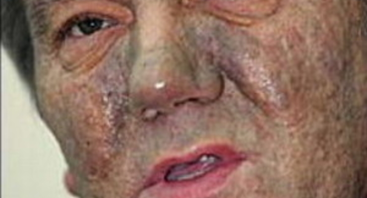 Французский врач Ющенко подтвердил, что тот был отравлен диоксином